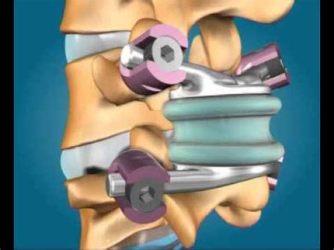 Premia Spine TOPS System How Does it Work.flv - YouTube