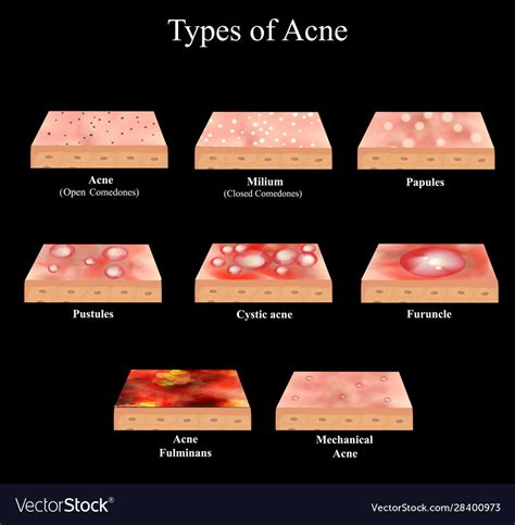 Types acne skin inflammation pimples boils Vector Image