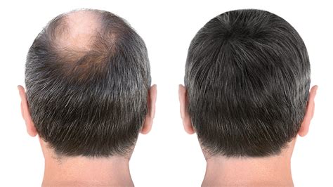 Minoxidil Before & After Pictures: Results From Month 1 To 12