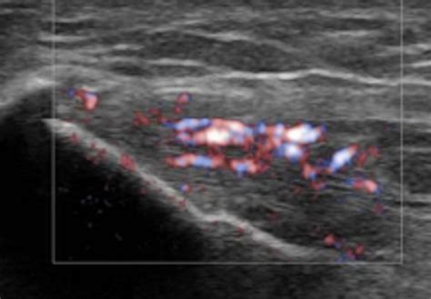 ELBOW - Advanced - Physicians of Sports & Orthopedic Medicine