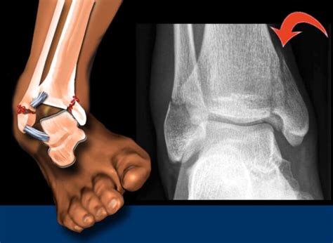 What To Do After An Ankle Fracture – [𝗣]𝗥𝗲𝗵𝗮𝗯