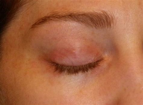 Rash on Eyelid - Pictures, Causes and Treatment