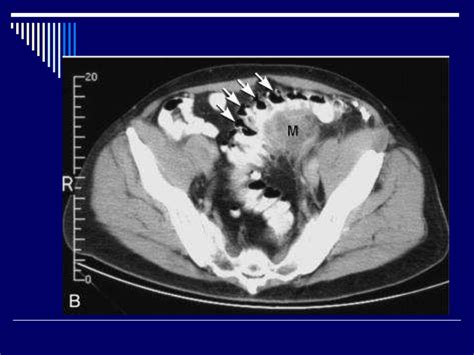 2017 Icd 10 Code For Diverticulosis Of Colon