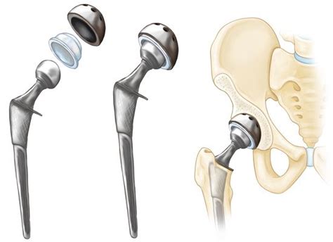 How Much Do Hip Replacements Cost in 2023? Without Insurance & Out-of-Pocket | Mira