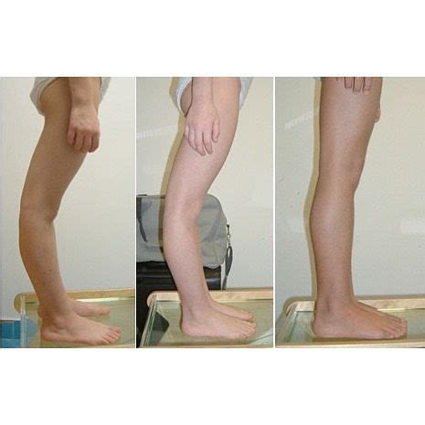 Genu recurvatum is a deformity in the knee joint so that the knee bends backwards. In this ...