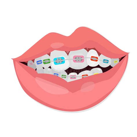 Teeth Braces. Vector Illustration on White Background Stock Illustration - Illustration of ...