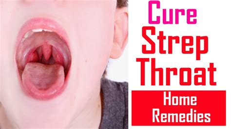 What Helps Strep Throat | Examples and Forms