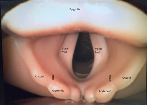 Direct Laryngoscopy Article