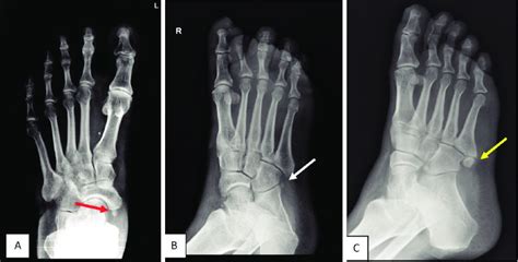 (A) AP view in foot radiograph showing Accessory navicular bone (red... | Download Scientific ...