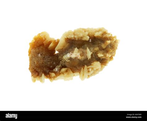 Human Male Calcium Oxalate Kidney Stone Stock Photo: 9626248 - Alamy