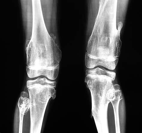 Radiodiagnosis - Imaging is Amazing-Interesting cases: Diaphyseal Aclasis-Hereditary multiple ...