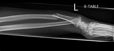 Galeazzi Fracture Classification