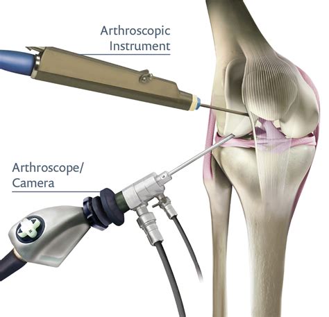 Knee Arthroscopy Perth | Dr Daniel Fick