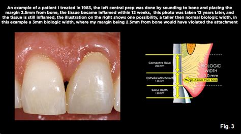 A Comprehensive Guide To Biologic Width - Spear Education