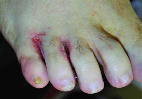 Onychomycosis causes, clinical appearance and onychomycosis treatment