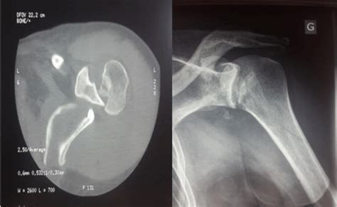 Radiograph and CT scan of the left shoulder reveal posterior... | Download Scientific Diagram