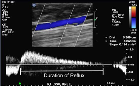 The Importance Of The Standing Reflux Ultrasound & Why You Should Insist On One - Get Healthy Veins