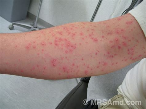 MRSA Pictures / Staph Infection Pictures/Graphic Images – MRSA MD