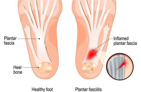 Cause and Symptoms of Plantar Fasciitis - Get Active Physiotherapy