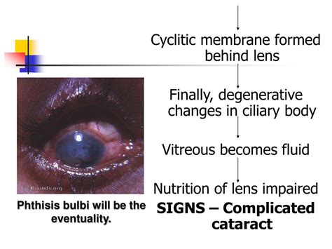 PPT - IRIDOCYCLITIS PowerPoint Presentation, free download - ID:4760201