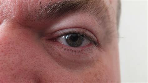 Reasons You Have Droopy Eyelids - Unbound