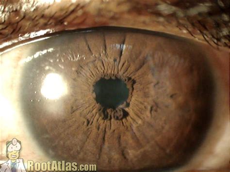 Ophthalmology : ectropion uvea | This photograph shows a nor… | Flickr