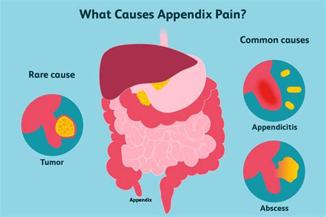 Appendicitis-Diagnosis And Treatment