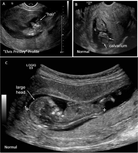 Check the Head: Emergency Ultrasound Diagnosis of Fetal Anencephaly - The Western Journal of ...