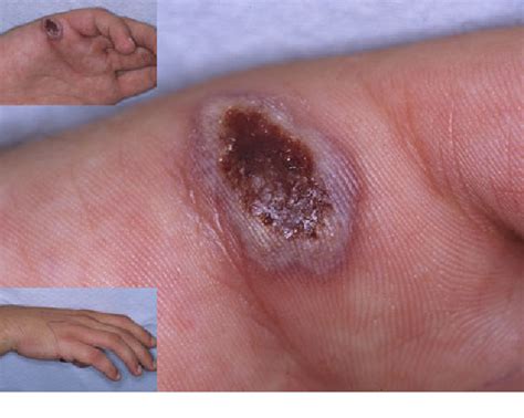 [PDF] Rare human skin infection with Corynebacterium ulcerans ...