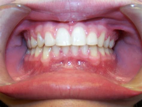 Great Smile - Deep Bite/Overlapping Teeth - Before and After Gallery