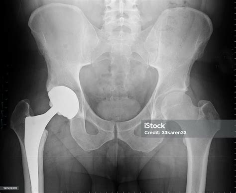 Xray Of Total Hip Arthroplasty Stock Photo - Download Image Now - Hip Replacement, X-ray Image ...