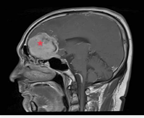 MRI (sagittal view) showing the anterior skull base meningioma (red ...