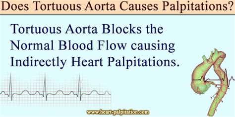 Does Tortuous Aorta Causes Palpitations - Heart-Palpitation.com