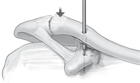 Acromioclavicular Joint Separation Treatment