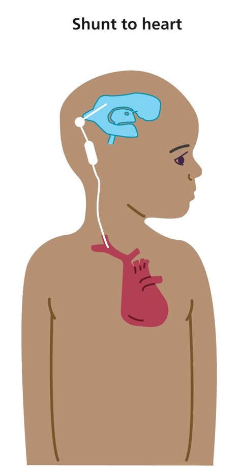 Shunts to treat hydrocephalus - Resource Library - Sheffield Children's NHS Foundation Trust