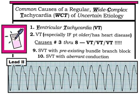 Ventricular Tachycardia Vs Supraventricular Tachycardia