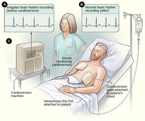 Cardioversion - Wikipedia