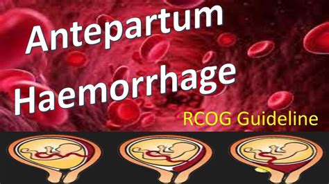 Antepartum Haemorrhage | RCOG Guideline - YouTube