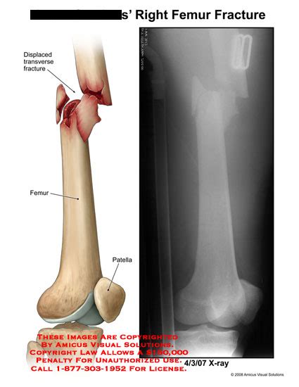 AMICUS Illustration of amicus,injury,femur,fracture,displaced,transverse,comminuted,patella,X-ray