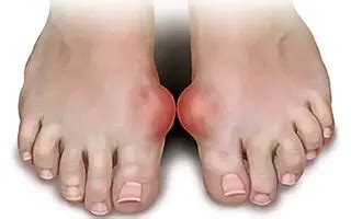 Gout: causes, symptoms and state-of-the-art treatments