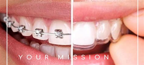 Invisalign vs Braces - Comfortho Invisalign ortho