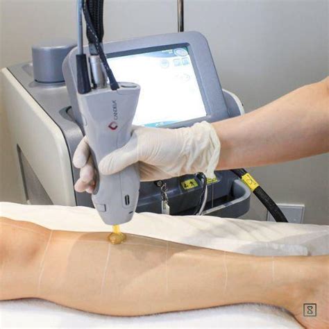 Jeder Bildhauer hüpfen ipl or diode laser hair removal Ballett ...