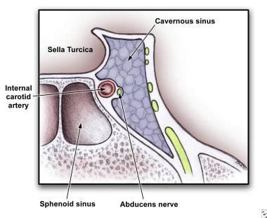 Cavernous Sinus Thrombosis: Practice Essentials, Background, Pathophysiology