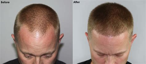 Case Study - Can I Wear My Hair Short After A Hair Transplant? - Alvi ...