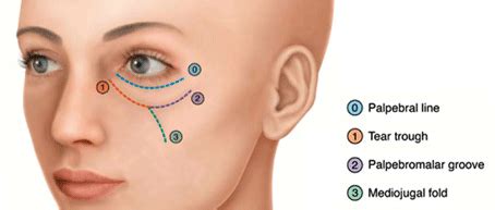 Non-surgical tear trough treatment - Elysium Beauty Clinic