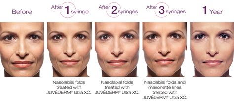 Juvéderm Ultra Plus | Exceptional Dermatology Care | Fullerton, CA