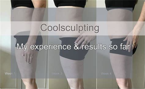 My experience with Coolsculpting and the results so far at just 4 weeks! #coolsculpting # ...