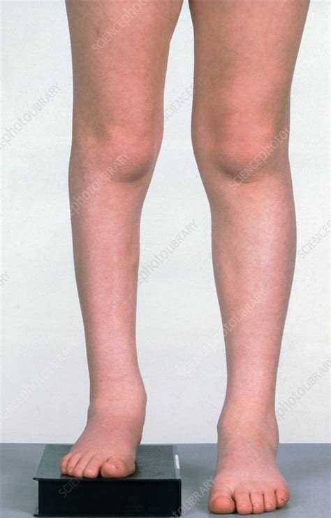 Paralysis short leg - Stock Image - C036/6339 - Science Photo Library