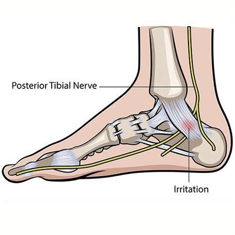 Chiropractic Treatment of Tarsal Tunnel Syndrome — ChiroUp