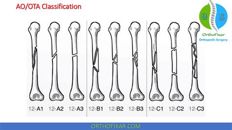 Types Of Splint For Humerus Fracture | motosdidac.es